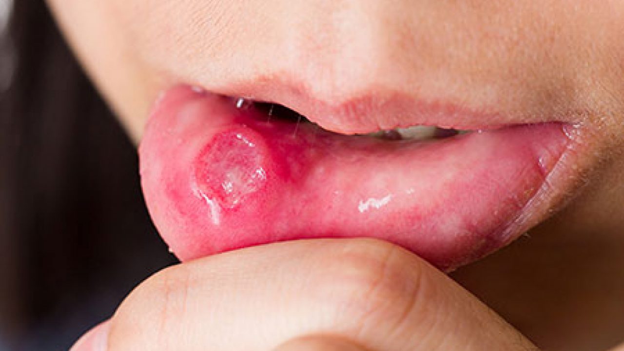 What Causes Canker Sores? How Can You Prevent Them?
