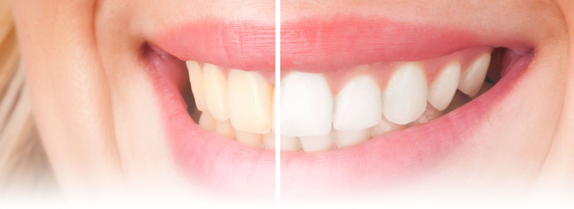 Teeth Whitening St. Louis MO - In-office Laser & At-home Whitening