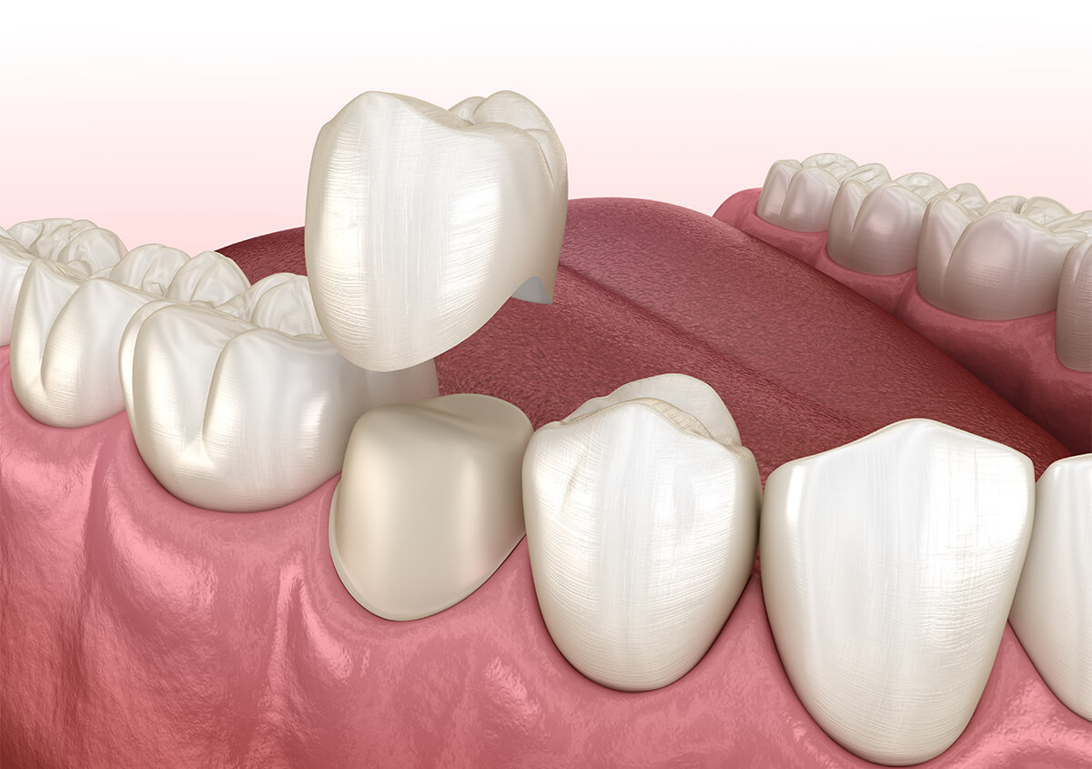 Crowns for Teeth in St. Louis MO Area