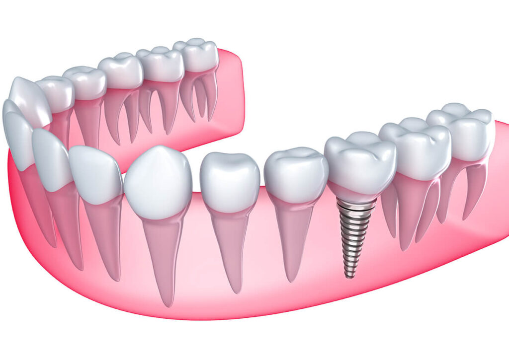 Dental Implant Healing Stages Your Guide to Every Step