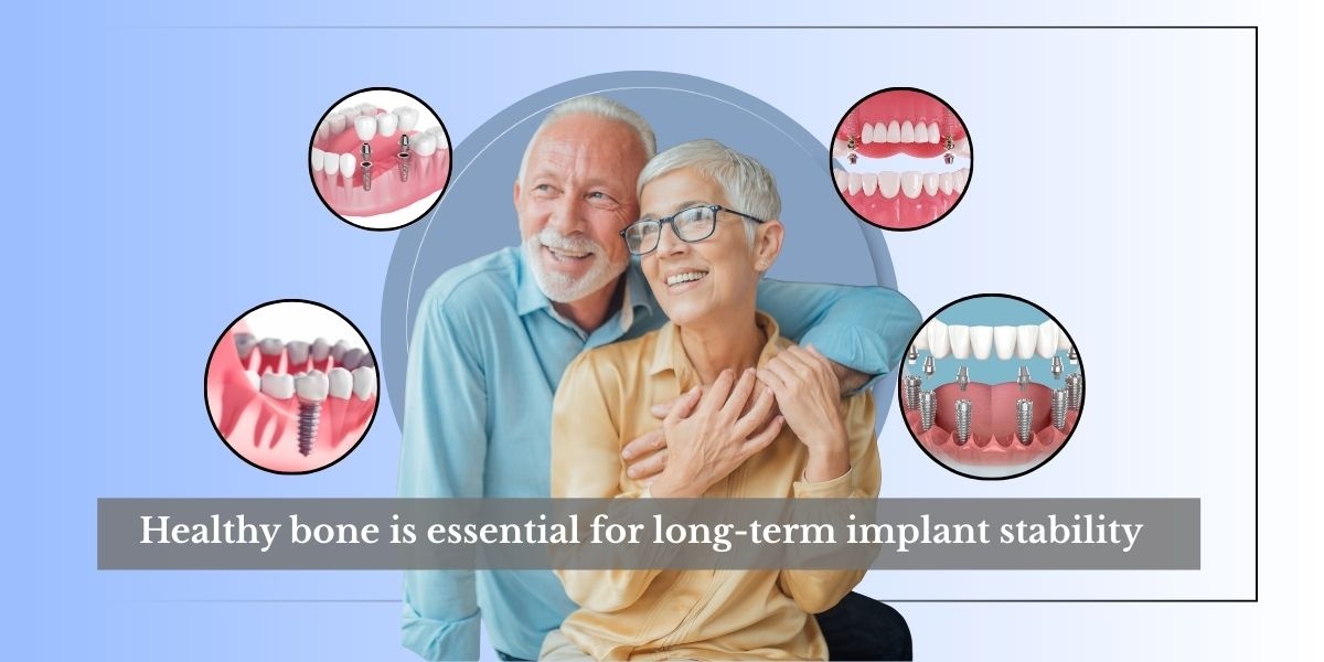 Upper-Jaw Implants Cover